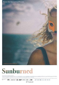 Sunburned